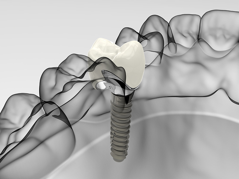 Dentista a San Giovanni Lupatoto | Studio Tomezzoli